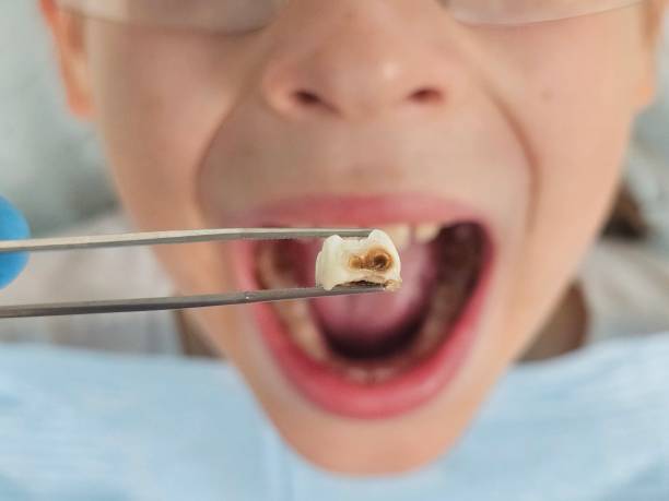 Best Emergency Tooth Extraction in Naranja, FL